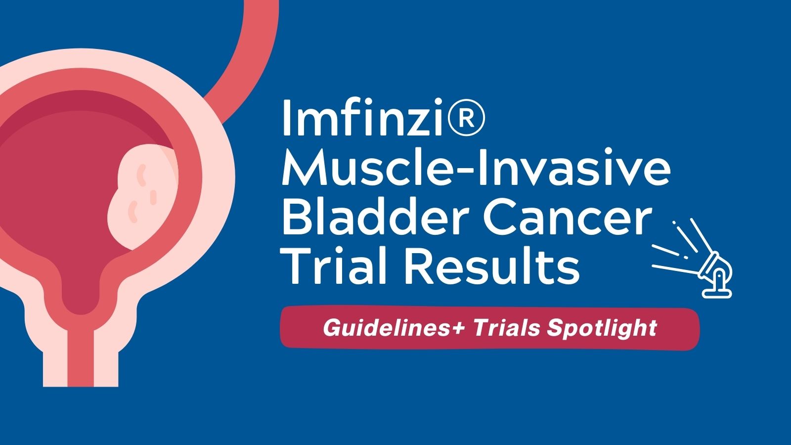 Guidelines+ Trials Spotlight - Imfinzi® Muscle-Invasive Bladder Cancer Trial Results NIAGARA