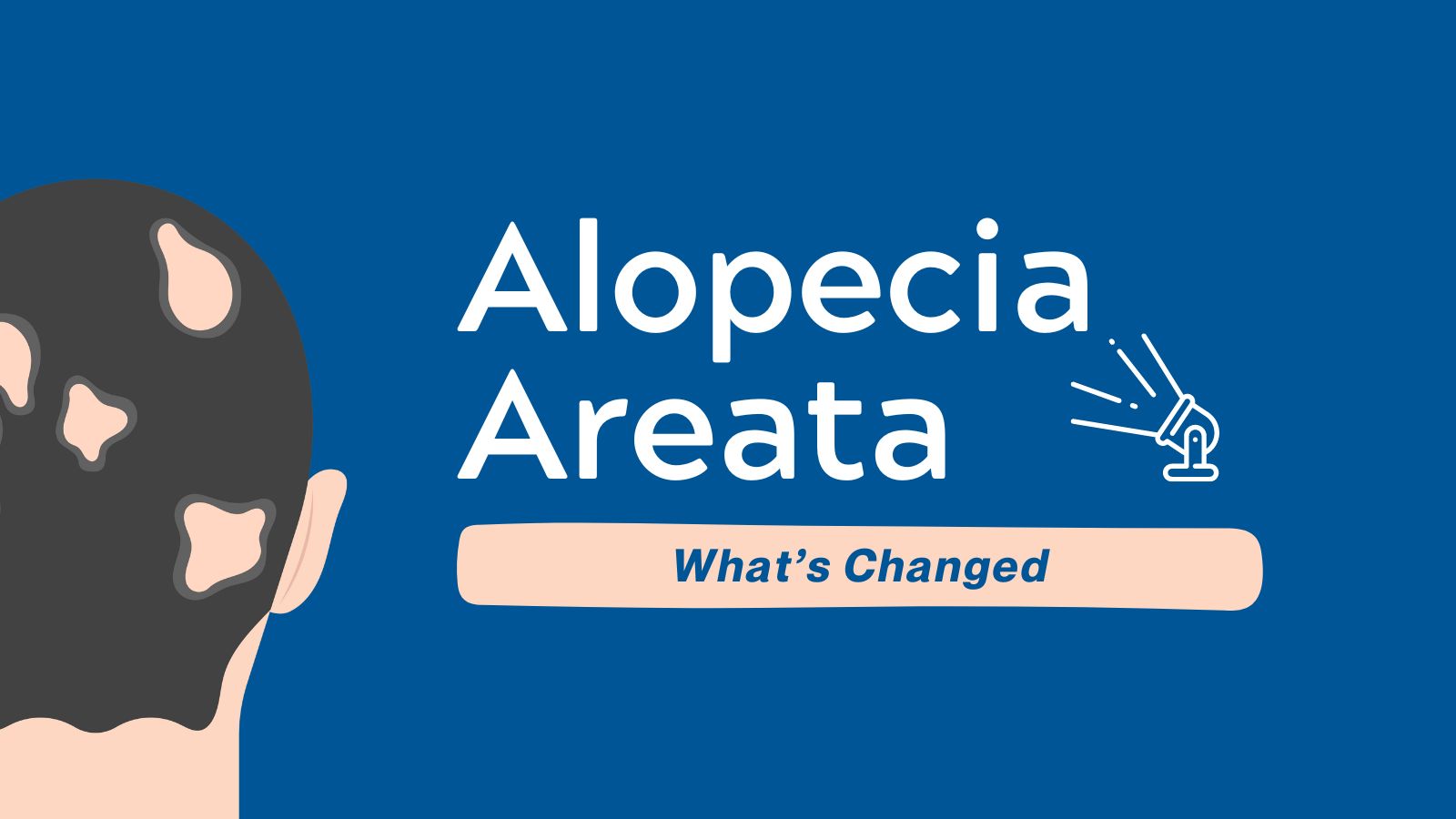 What's Changed Alopecia Areata