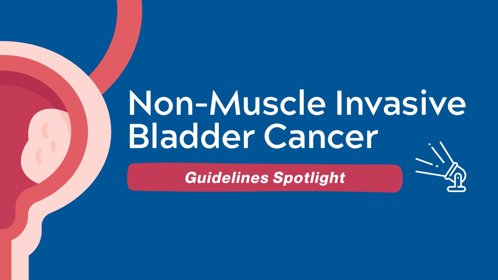 Guidelines Spotlight Non-Muscle Invasive Bladder Cancer